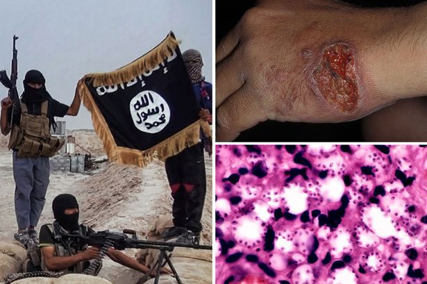 Mortal enfermedad se propaga en miles de terroristas del llamado Estado Islámico. FOTO © The Daily Mirror